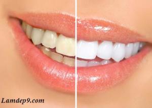 Cách tẩy trắng răng hiệu quả, nhanh và đơn giản tại nhà